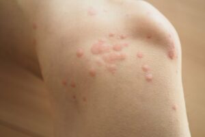 蕁麻疹が出る場所のスピリチュアルな意味　身体と感情が伝えるメッセージ
