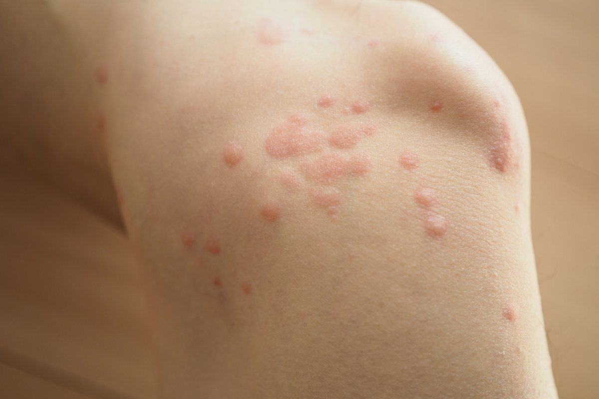 蕁麻疹が出る場所のスピリチュアルな意味 身体と感情が伝えるメッセージ