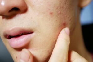 好転反応でニキビが出る特徴と対処法　他のニキビとの見分け方も解説